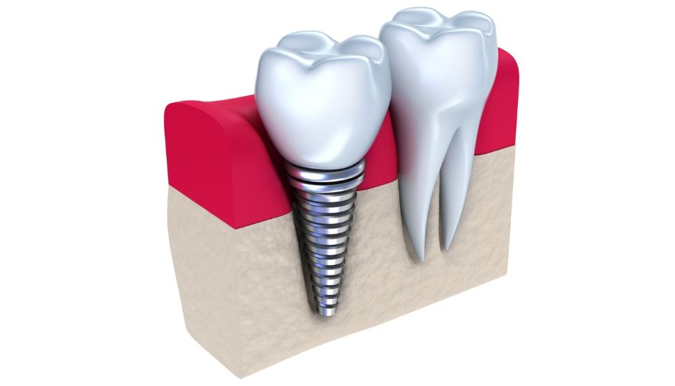 Dental Implant illustration