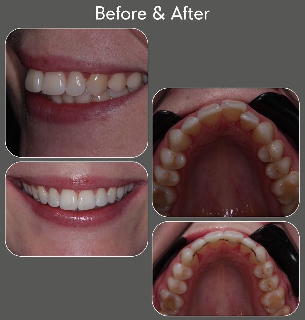 aligner