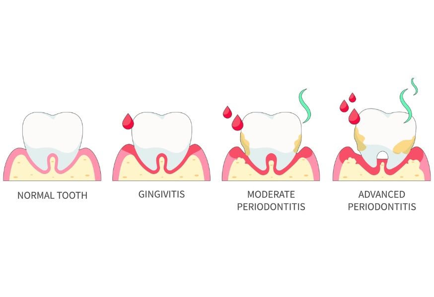 Gum Disease