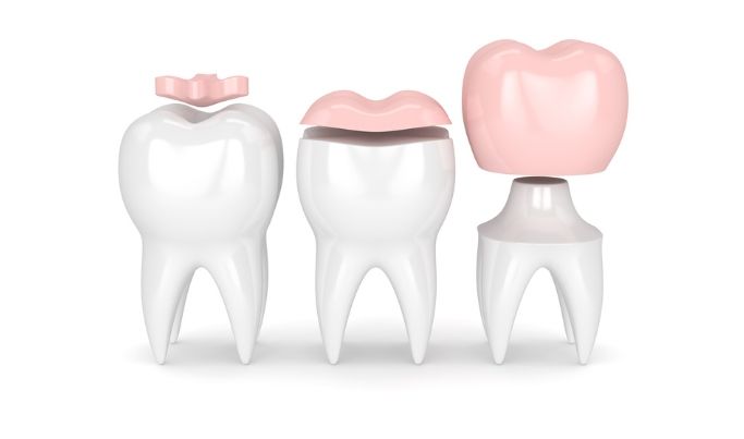 Crowns, onlays, veneers