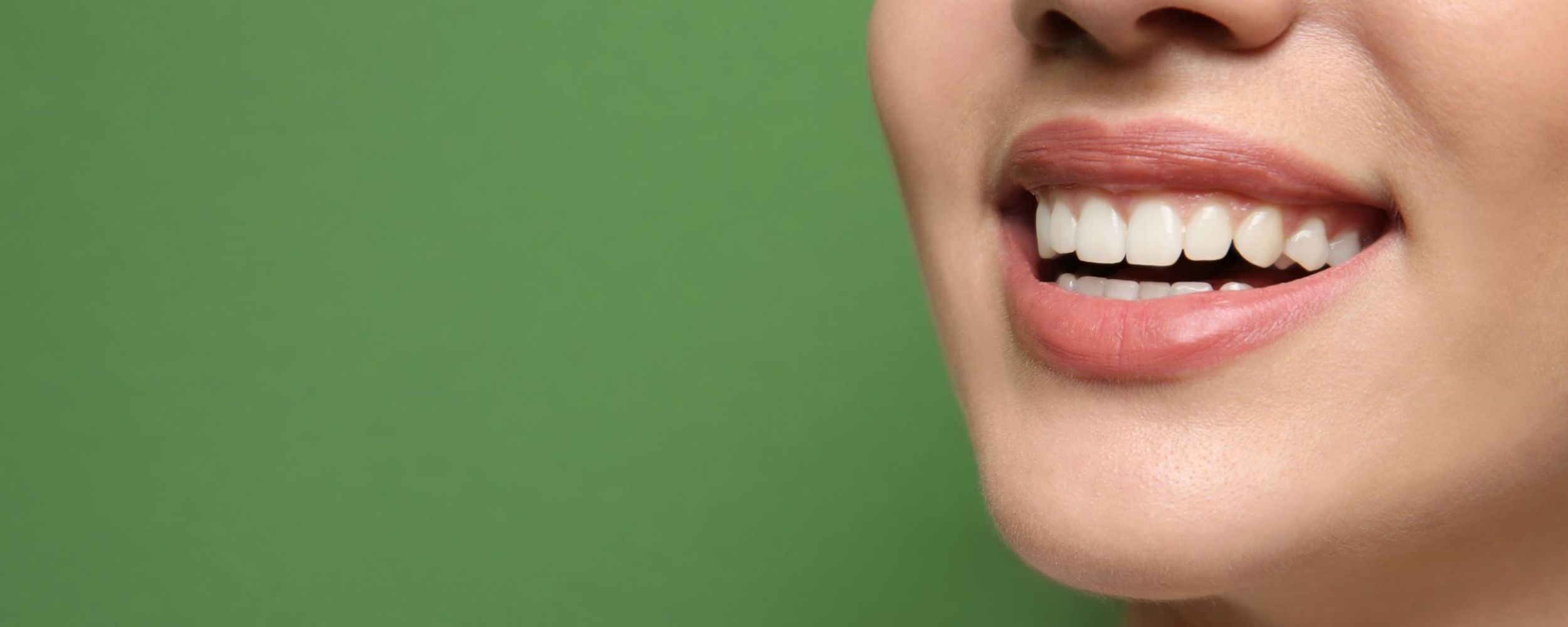 Veneers