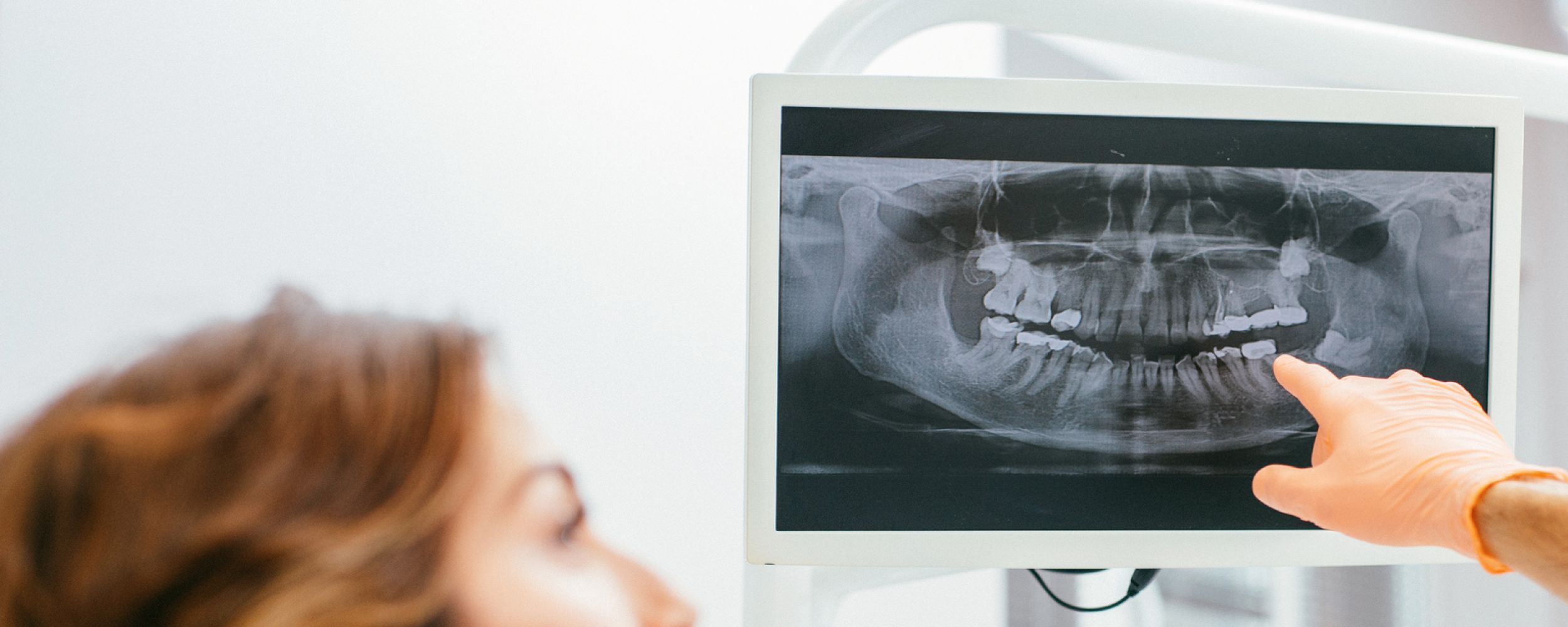 Broken teeth